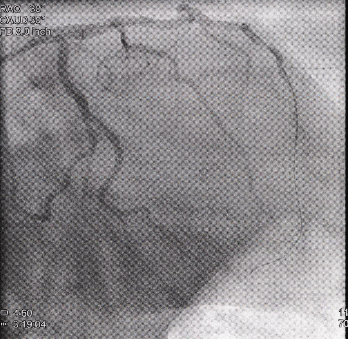 Sheryl's heart attack: after